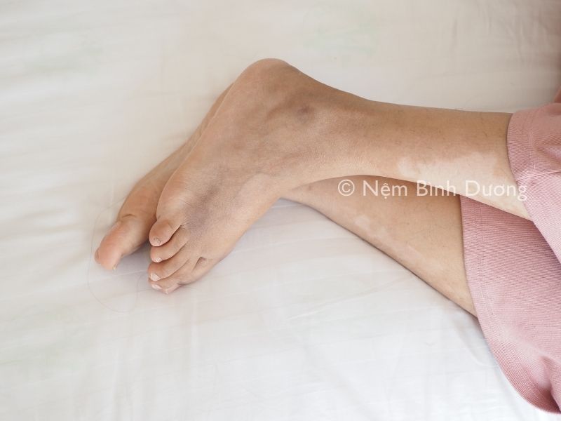 Rối loạn vận động tay chân theo chu kỳ ngủ là gì? Có nguy hiểm không?