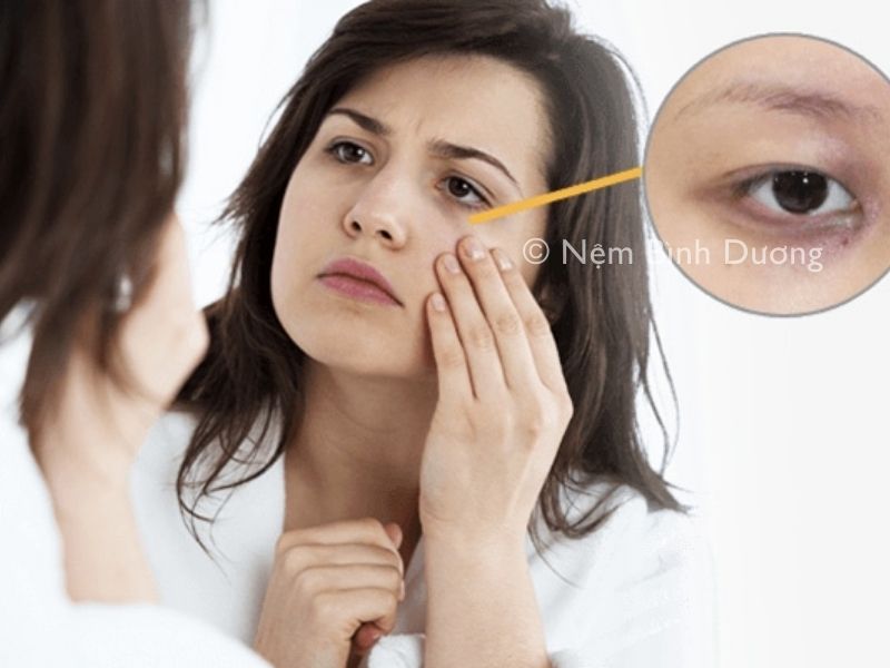 Ngủ sớm mà mắt vẫn thâm - Lý do vì sao? Cách điều trị hiệu quả2 Ngủ sớm mà mắt vẫn thâm - Lý do vì sao? Cách điều trị hiệu quả