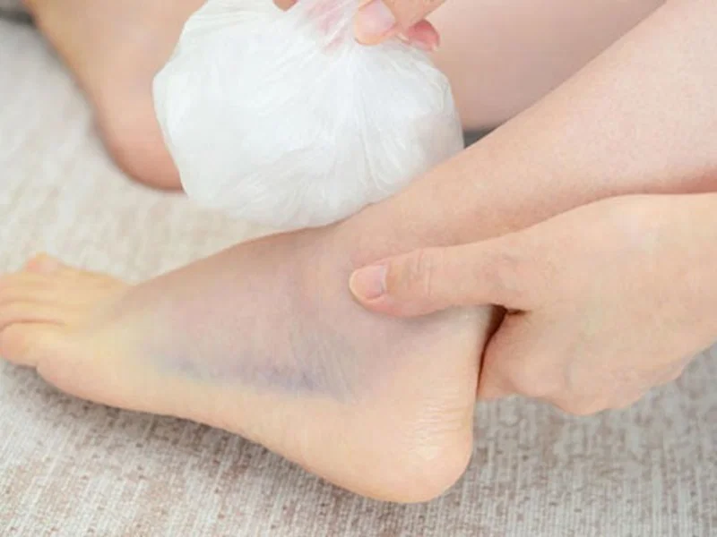 Cách sơ cấp cứu khi bị sưng đau mắt cá chân